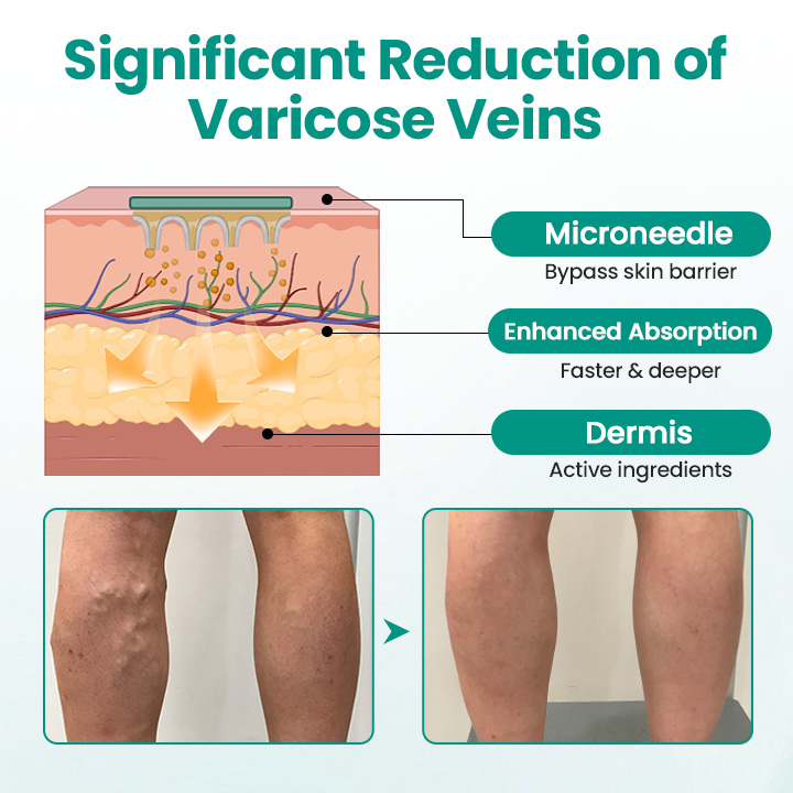 Juxek® LegRenew Varicose Veins Patch