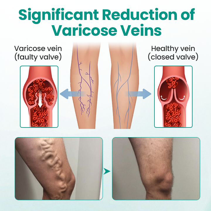 Juxek® LegRenew Varicose Veins Patch