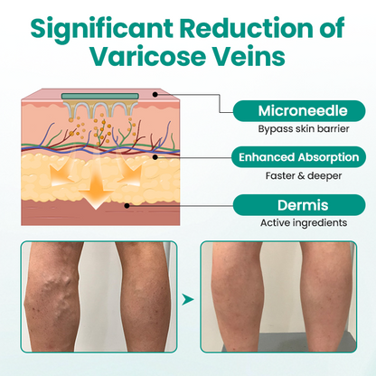 Juxek® LegRenew Varicose Veins Patch